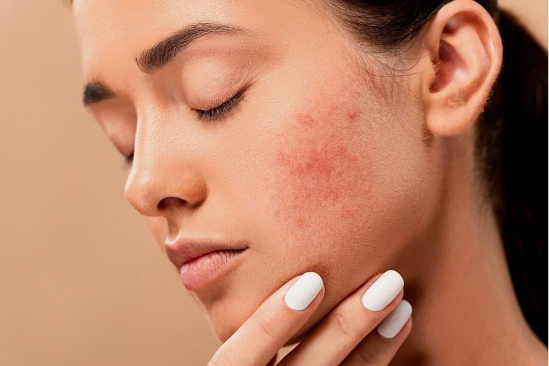 Acne on face caused by poor daily routine