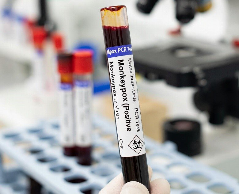 Monkey pox blood sample shown in lab test