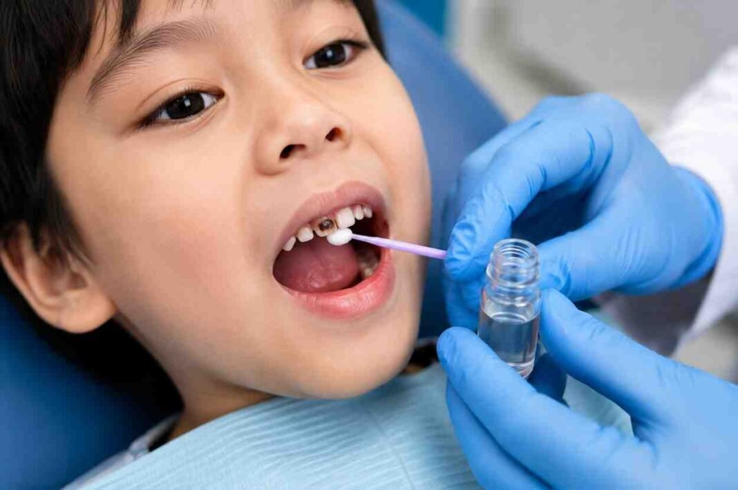 toothdeca Dentist applying Silver Diamine Fluoride treatment to a child's decayed tooth.