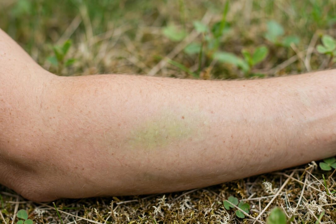 Why Do I Bruise So Easily? Common Causes Why Do I Bruise So Easily? Common Causes