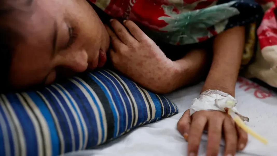 13 measles cases recorded in South Waziristan in two days measles South Waziristan