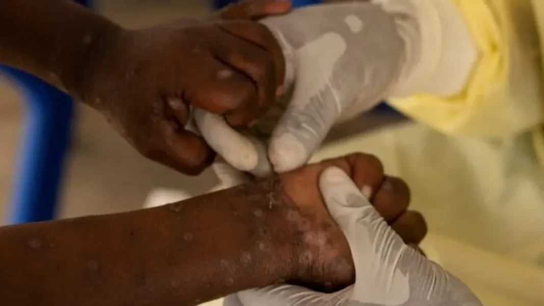 Another Child Dies of Mpox in Sindh as Death Toll Reaches 12 Sindh mpox death toll: health worker examines a child's arm